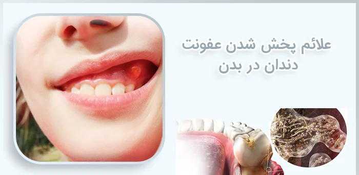 علائم پخش شدن عفونت دندان در بدن و راه کارهای درمان