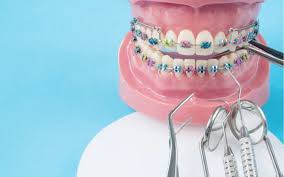 ارتودنسی چیست و برای چه کسانی استفاده میشود؟مراحل دقیق ارتودنسی