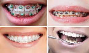 ارتودنسی چیست و برای چه کسانی استفاده میشود؟مراحل دقیق ارتودنسی