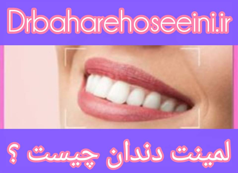 مراحل لمینت دندان و نکات کلیدی